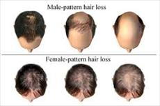 دستورالعمل و آموزش چگونگی تجویز محلول رویش مو و استفاده کارساز از محلول رویش موی دکتر نوروزیان